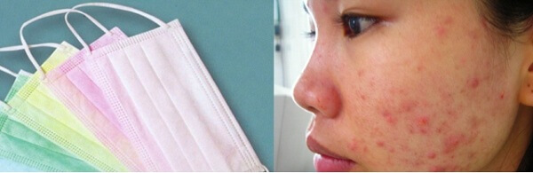 Kinh-hoang-khau-trang-kem-chat-luong-gay-nen-mun