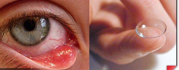 tac-hai-cua-kinh-ap-trong-kem-chat-luong